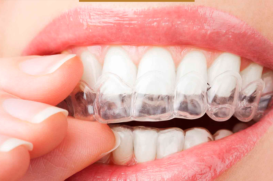 Ortodontia com Alinhadores Invisíveis